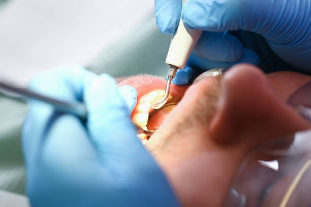 Best Dental Abscess Treatment in Gowanda, NY