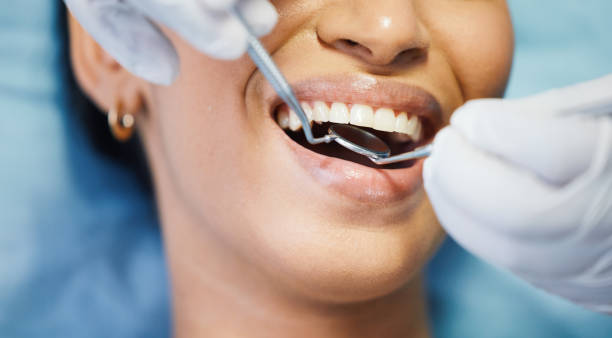 Best Knocked-Out Tooth (Avulsed Tooth) Treatment in Gowanda, NY